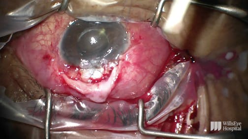 Combined Bleb Revision and Patch Graft