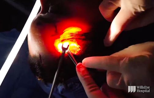 Blepharoplasty and Endoscopic Brow Lift