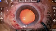 ZEISS QUATERA 700 Cataract Removal Case 2 plus ZEISS CT LUCIA 621P Implant