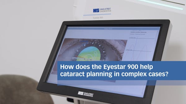Planning Complex Cataract Cases With the Eyestar 900 thumbnail