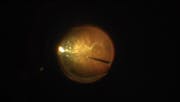 Detaching (or Not Detaching) the Posterior Hyaloid in Patients With Symptomatic Vitreous Opacities
