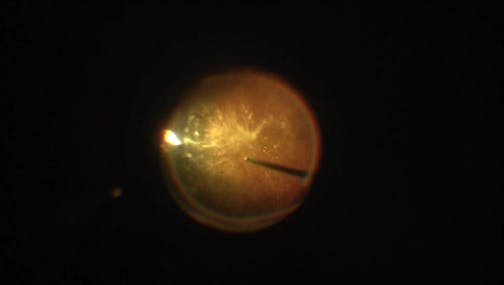Detaching (or Not Detaching) the Posterior Hyaloid in Patients With Symptomatic Vitreous Opacities