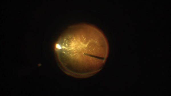 Detaching (or Not Detaching) the Posterior Hyaloid in Patients With Symptomatic Vitreous Opacities thumbnail