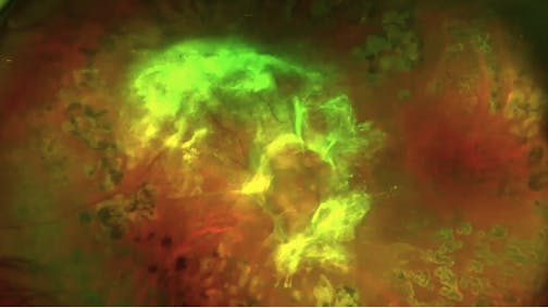 New Technique for Diabetic Dissection