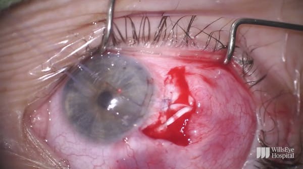 Intracorneal Tube Revision thumbnail