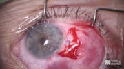 Intracorneal Tube Revision