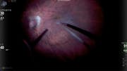 ERM in High Myopia
