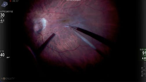 ERM in High Myopia
