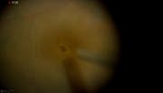 Refractory Macular Hole