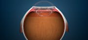 Iridex PSLT™ (Pattern Scanning Laser Trabeculoplasty) treatment for IOP Reduction