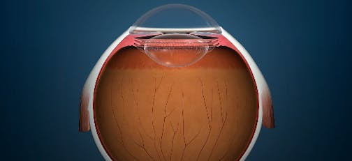 Iridex PSLT™ (Pattern Scanning Laser Trabeculoplasty) treatment for IOP Reduction
