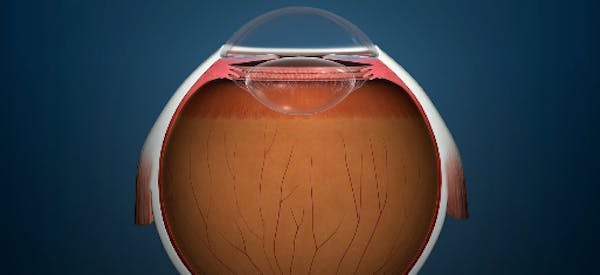 Iridex PSLT™ (Pattern Scanning Laser Trabeculoplasty) treatment for IOP Reduction thumbnail