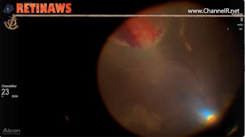 Vasoproliferative Tumor