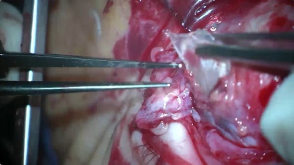Infected Scleral Buckle thumbnail