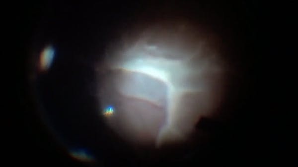 External Subretinal Membrane Removal thumbnail
