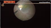 Optic Nerve Pit