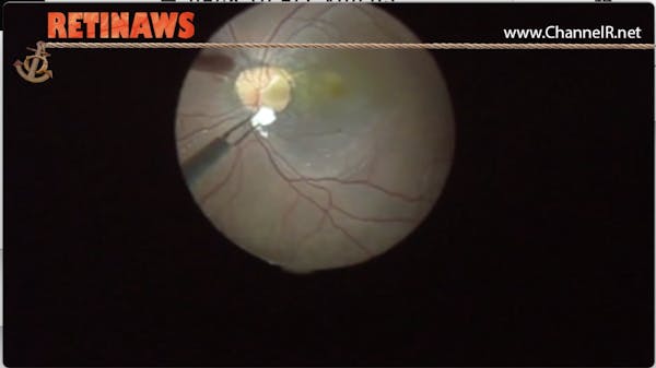Optic Nerve Pit thumbnail