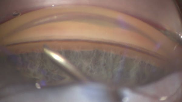 iAccess Microgoniotomy With iStent inject W thumbnail