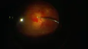 Anterior Vitreous Hemorrhage