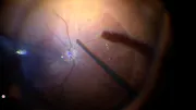 Macular Fold