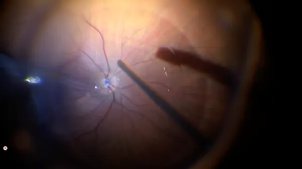 Macular Fold thumbnail