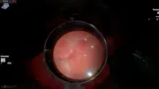 Suprachoroidal Buckle
