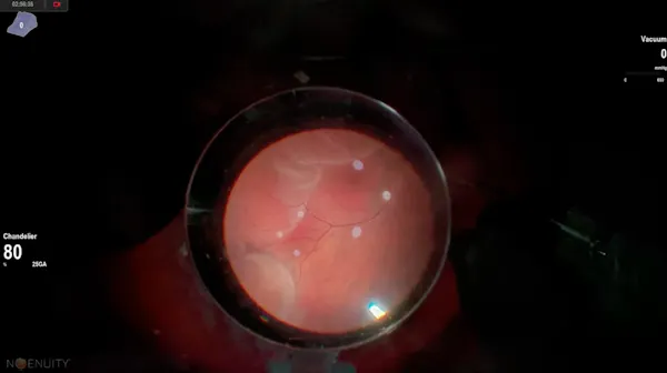 Suprachoroidal Buckle thumbnail