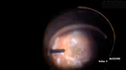 Life Saving Vitreoretinal Surgery