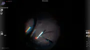 Ozurdex Implant