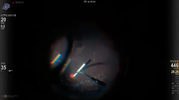 Ozurdex Implant thumbnail