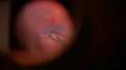 Gasless Macular Hole Surgery