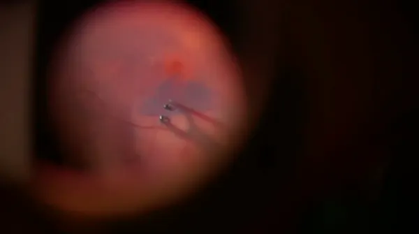 Gasless Macular Hole Surgery thumbnail