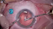 Ozurdex in the Lens