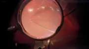 Retinal detachment