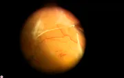 Traction Retinal Detachment