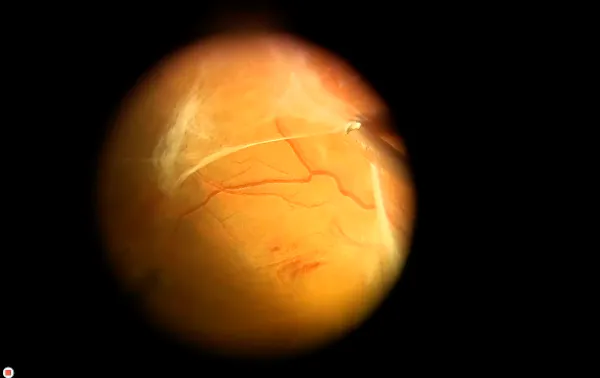 Traction Retinal Detachment thumbnail