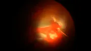 Severe Diabetic TRD