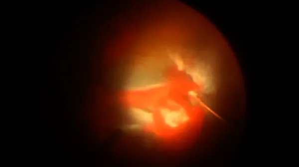 Severe Diabetic TRD thumbnail