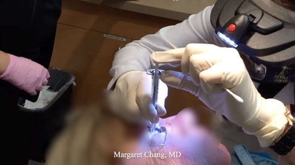 Susvimo: Implant Refill thumbnail