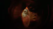 Dense Cataract