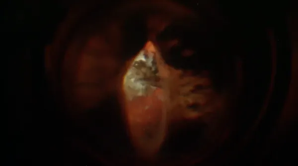 Dense Cataract thumbnail