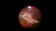 Myopic Macular Hole