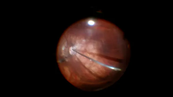 Myopic Macular Hole thumbnail