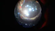Scleral Buckle