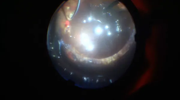 Scleral Buckle thumbnail
