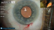 A Step by Step Phacoemulsification Procedure with Dr. Eva Liang