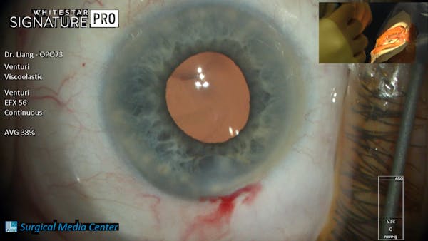 A Step by Step Phacoemulsification Procedure with Dr. Eva Liang thumbnail