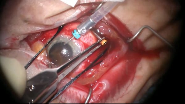Choroidal Hemorrhage After Cataract Surgery thumbnail