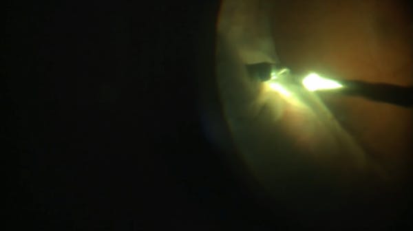 Retinal Detachment and Vitreous Hemorrhage thumbnail