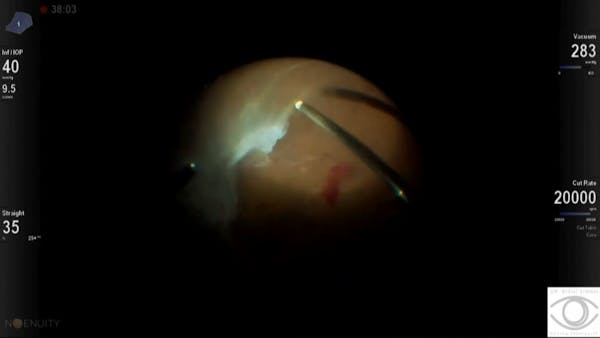 Complex Tractional Retinal Detachment thumbnail